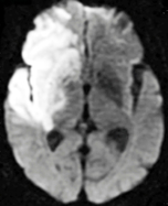 Trace DWI stroke