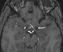 Gradient Echo (GRE) Inflow enhancement