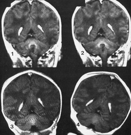 gadolinium in infants