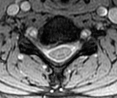 Spoiled GRE contrast