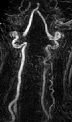 TOF MRA artifacts: flow reversal