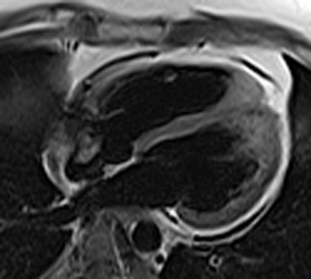 Long-axis double IR image of heart