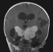 gadolinium in infants