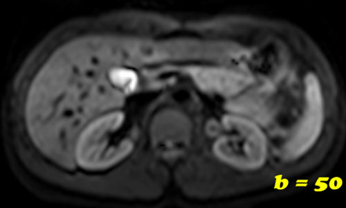 Diffusion MRI b-value