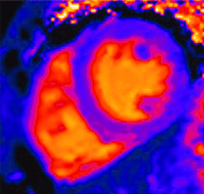 cardiac T1 map