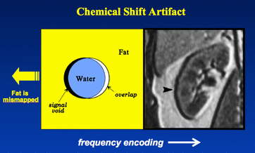 Chemical Shift Artifact