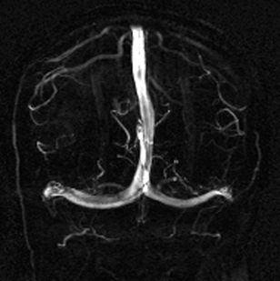 Phase Contrast MRA