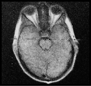 zipper artifact MRI