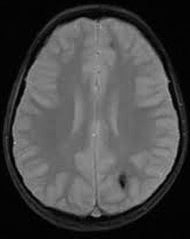 T2* GRE image gradient echo