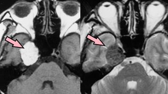 MRI, melanoma, T1 short