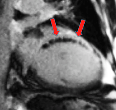 MVO MRI