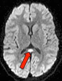 Causes of restricted diffusion MRI: intramyelinic edema