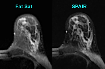 SPAIR (SPectral Attenuated Inversion Recovery)