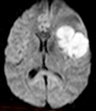 Causes of restricted diffusion MRI: lymphoma