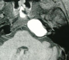 MRI, T1, cholesterol granuloma,