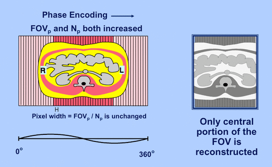 phase oversampling MRI