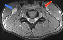 Time-of-flight effects MRI and MRA