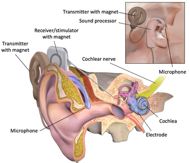 Cochlear implant