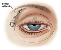 Morel-Fatio eyelid spring