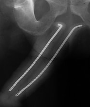 penis implant xray