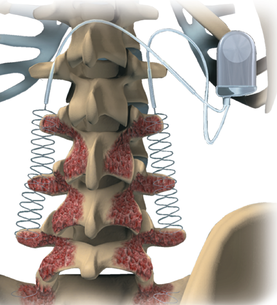 Spinal fusion stimulator