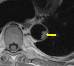 MRI, T1, cholesterol, Atherosclerotic plaque