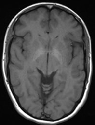 gadolinium accumulation in tissues