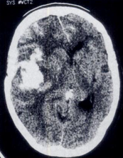 aneurysm bleed mri