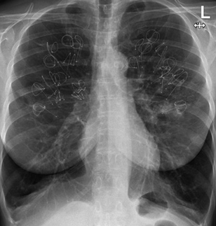 Endobronchial coils