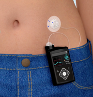 insulin pump