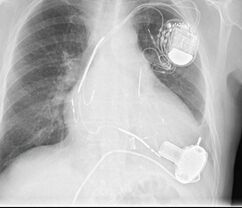 Left Ventricular Assist Device (LVAD)