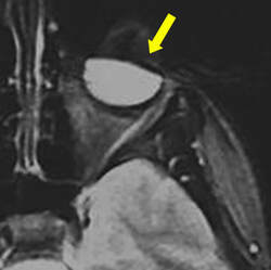 mascara artifact MRI