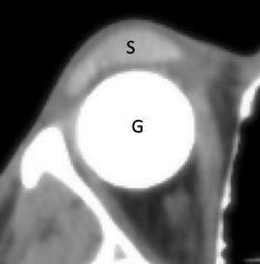 hydroxyapatite eye prosthesis