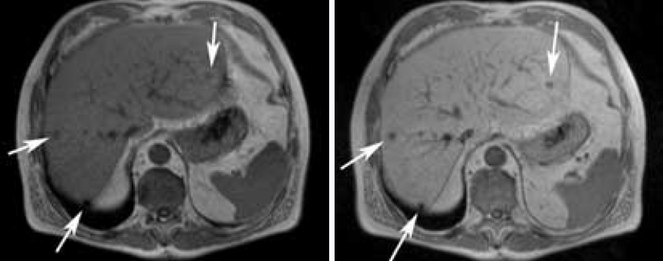 Mn accumulation basal ganglia