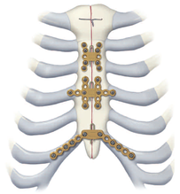 Titanium Sternal Fixation System